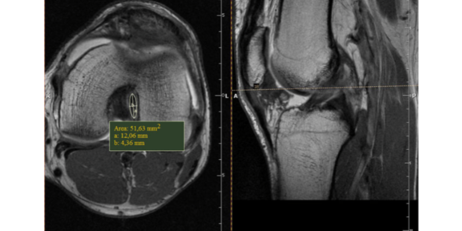 Ein starkes Kreuzband durch Krafttraining